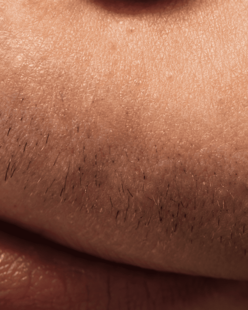 How to Get Rid of Mustache Shadow: A Complete Guide for Men